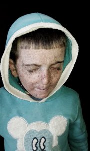 KAFARya boy with skin cancer